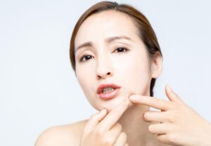 にきびケア